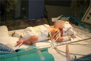 Realizan por primera vez operación del corazón a un bebé