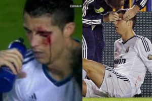 VIDEO: Cristiano Ronaldo termina con el párpado roto en partido contra el Levante