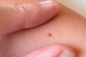 Lunares que causan dolor pueden ser indicadores de cáncer de piel, afirman dermatólogos