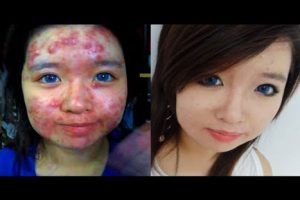 Impactante: Joven muestra en un tutorial cómo cubre su acné severo – VIDEO
