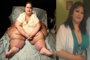 Impresionante: «la mujer más obesa del mundo» pierde 272 kilos