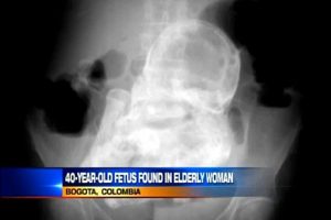 Anciana descubre que tenía un feto de 40 años en su cuerpo