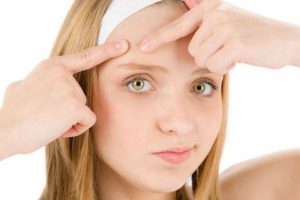 5 remedios caseros para el acné