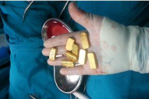 De terror: médicos encuentran oro dentro del estómago de un enfermo