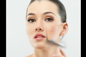 Tips para eliminar el acné