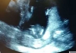 No creerás cómo este feto de 14 semanas aplaude durante una ecografía (VIDEO)
