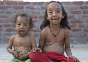 ¡Increíble! Dos niños sufren la misma ‘enfermedad’ que ‘Benjamin Button’ (FOTOS)