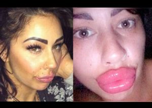 Viral: Se aumentó los labios y quedó descontenta por este motivo – FOTOS