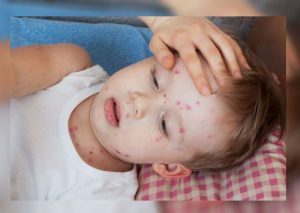 Padres: ¿Cómo evitar una fuerte infección si tu hijo tiene varicela? (VIDEO)