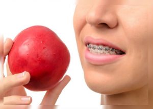 Alimentos perjudiciales que dañan tu tratamiento de ortodoncia